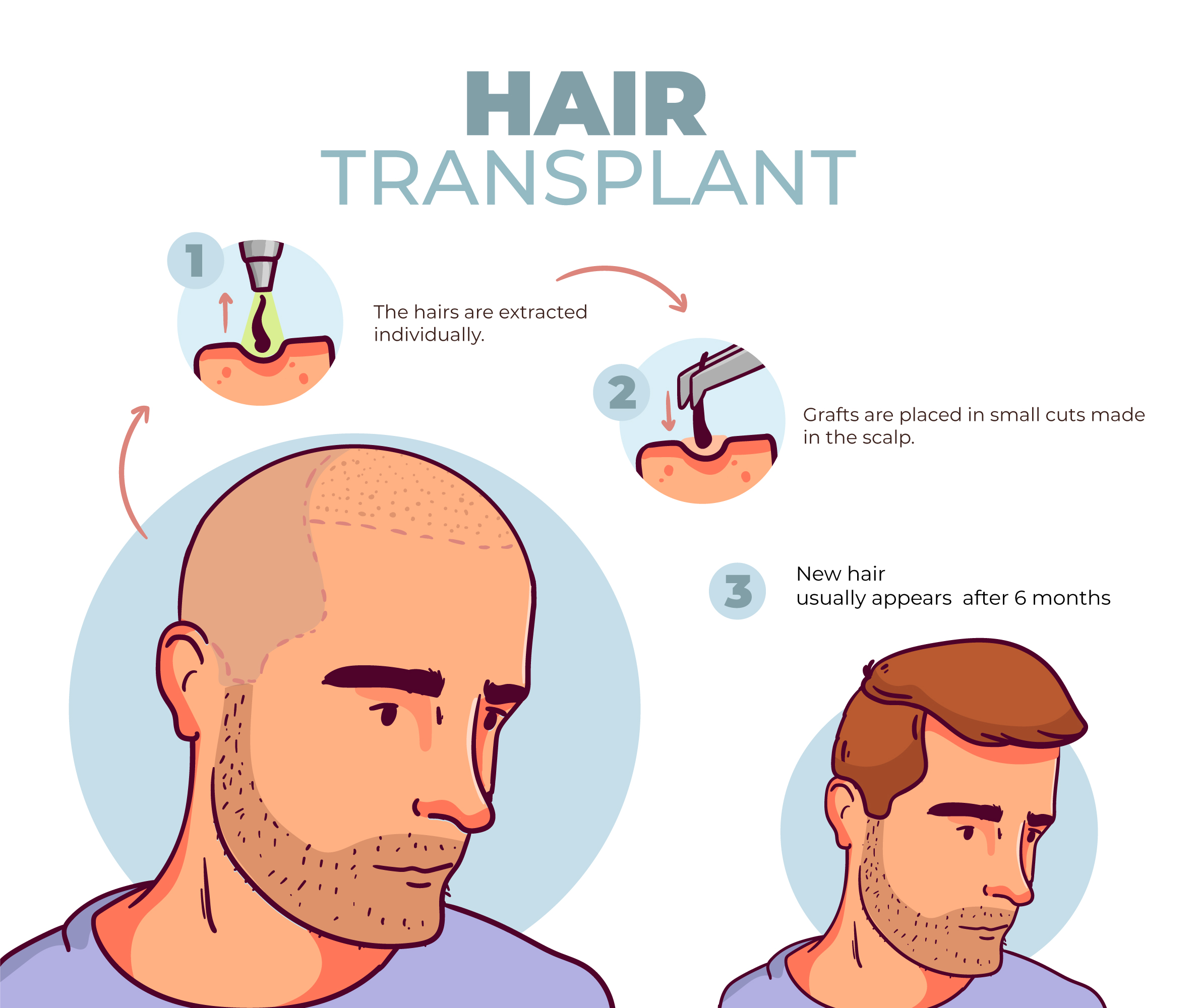 Hair Transplant in College Road Nashik