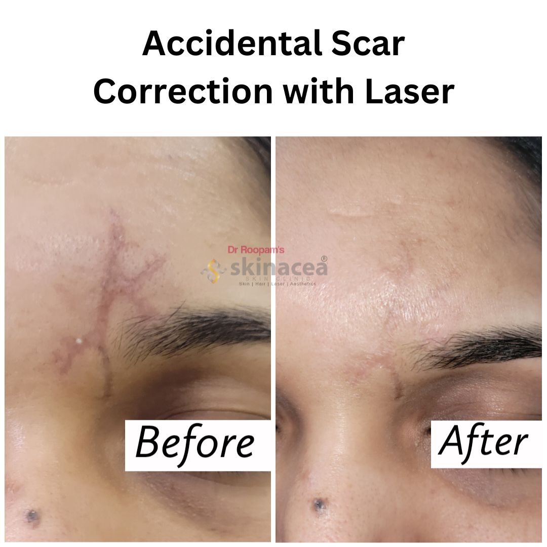 Scar Laser Treatment in Bombay Naka Nashik