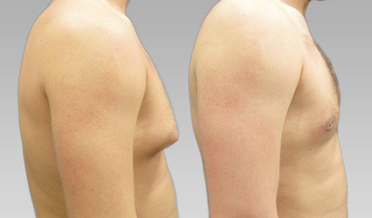 Gynecomastia