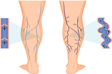 Laser Varicose Veins